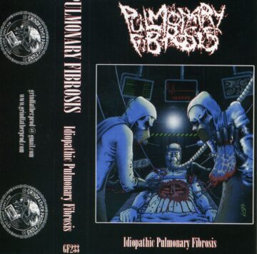 Pulmonary Fibrosis - Idiopathic Pulmonary Fibrosis (Cassette)