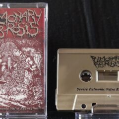 Pulmonary Fibrosis - Severe Pulmonic Valve Regurgitation (Cassette)