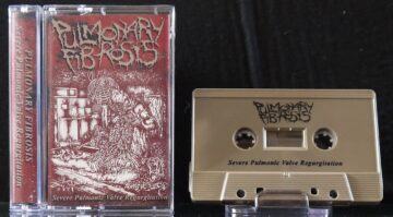 Pulmonary Fibrosis - Severe Pulmonic Valve Regurgitation (Cassette)