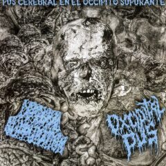 Cerebral Suppuration / Oxcipital - Pus Cerebral En El Occipito Supurante