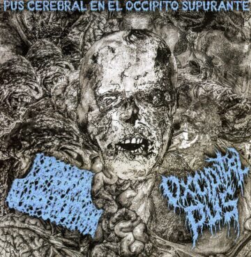 Cerebral Suppuration / Oxcipital - Pus Cerebral En El Occipito Supurante